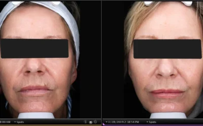 Photodynamic therapy