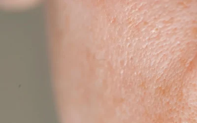 Pigmentation